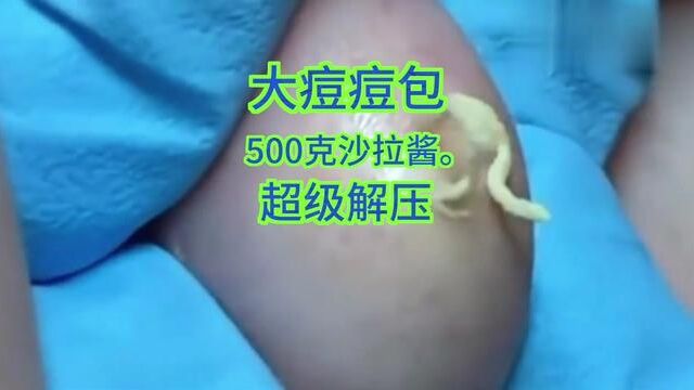 八八年美女没挤过的痘痘500克#解压 #痘痘黑头粉刺拜拜 #强迫症看了很享受 #创作灵感 #歌手王家太