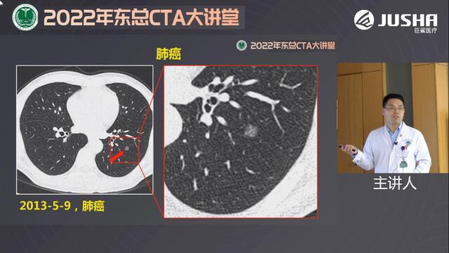 冠状动脉CTA的综合评估东部战区总医院张龙江