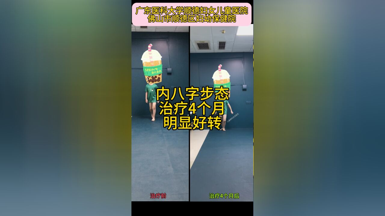 小腿内旋导致的内八字步态,治疗4个月,明显好转.