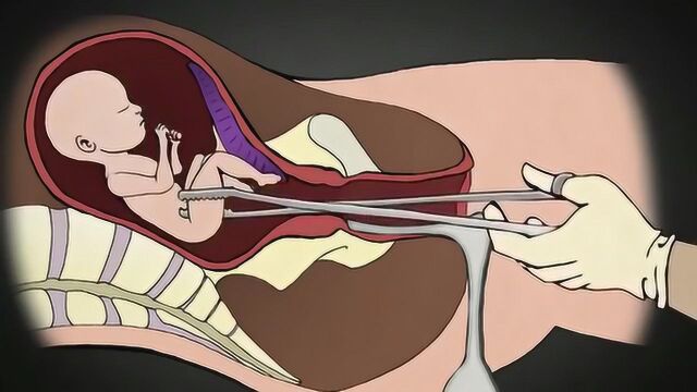 人流手术是怎么操作的?3D动画演示全过程,网友:看完心情复杂