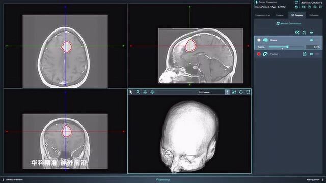 神外手术计划软件SinoPlan