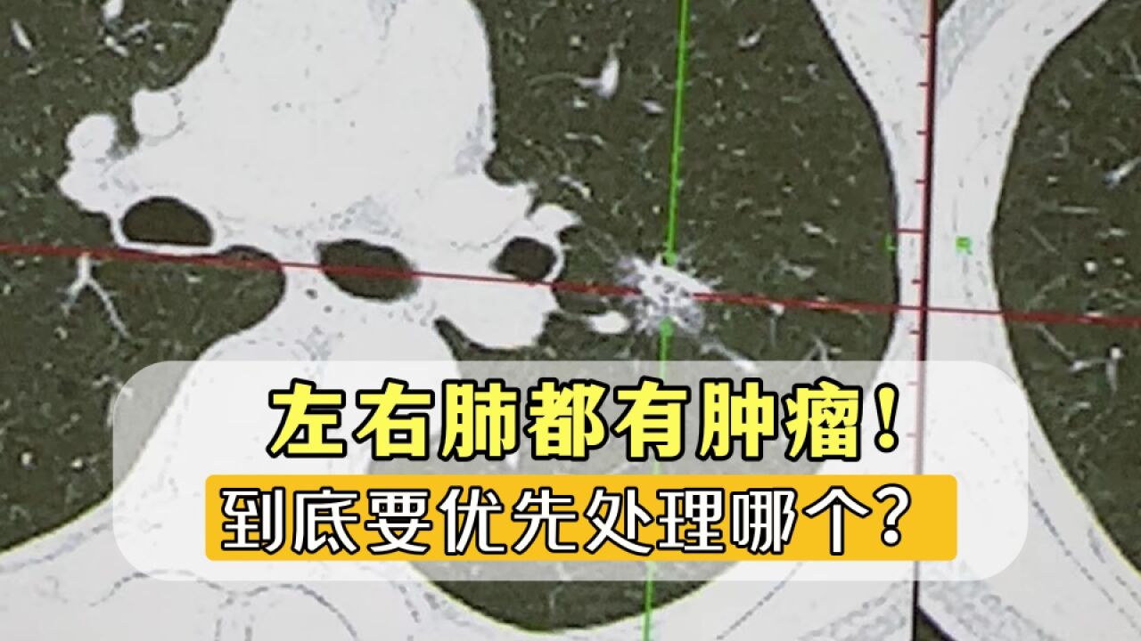 左右肺病灶,都怀疑是肿瘤!到底要优先处理哪一边?