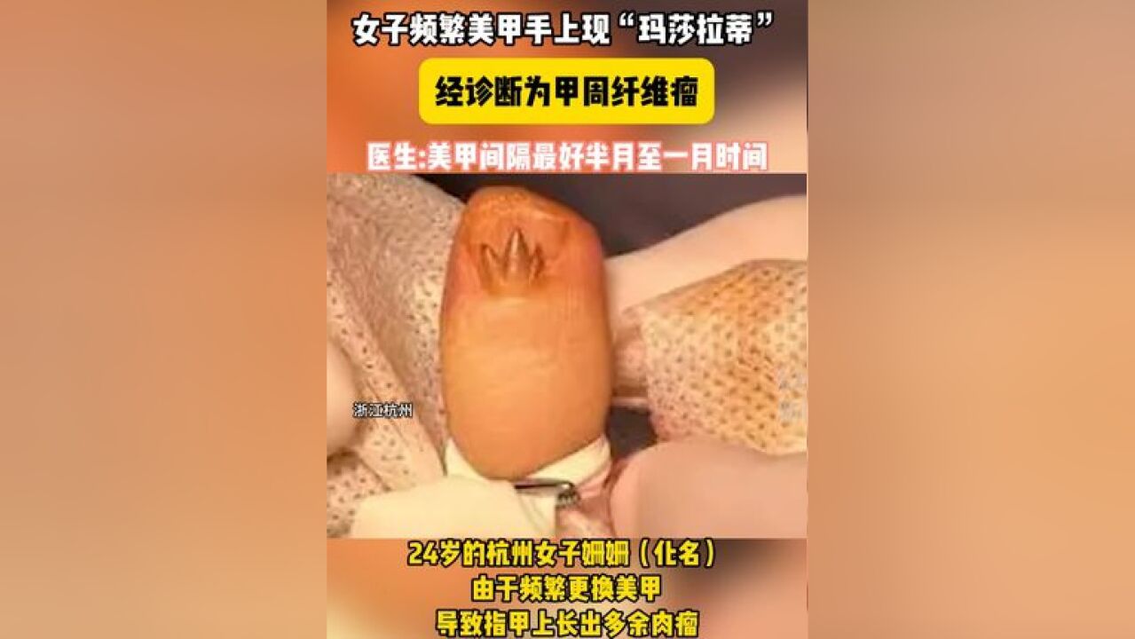 注意!杭州一女孩指甲惊现“玛莎拉蒂”标志 医生:这是甲周纤维瘤 与频繁美甲有关