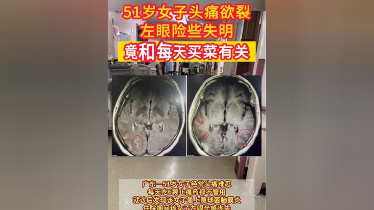 51岁女子头痛欲裂,左眼险些失明!竟和每天去买菜有关?