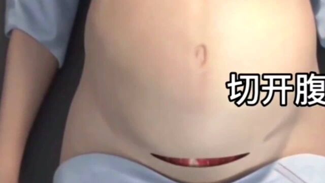 剖腹产全过程