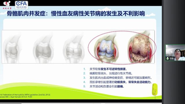 6月16号直播回放 儿童血友病并发症的管理 汪俭 毛岭