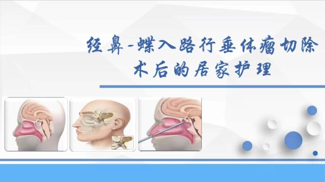 经鼻蝶入路行垂体瘤切除术后的居家护理之鼻腔冲洗篇