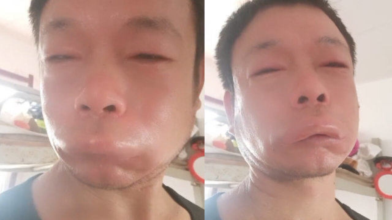 男子查看自家授粉蜂脸被蜇肿:妻子骑着电三轮路过,蜜蜂受惊