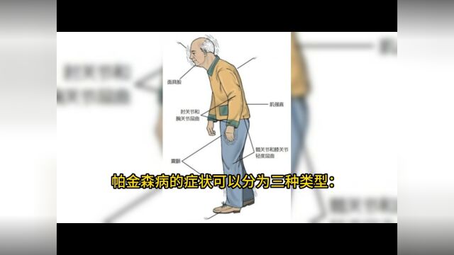 帕金森症状