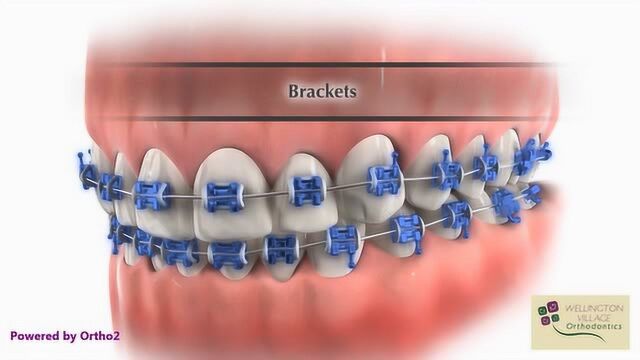 传统金属牙套矫正牙齿过程,动画演示!