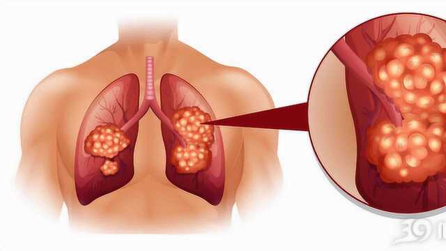 哪些靶向药治肺癌效果好?医生一口气说了5种,你知道几个