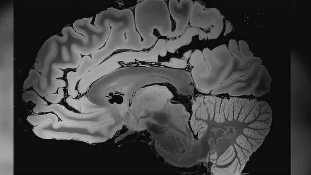 100小时的磁共振成像展现迄今最详细人脑图像