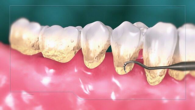 牙医究竟是怎样清洗黄色牙垢的?3D动画演示全程,看完心情舒畅