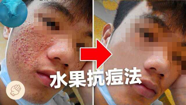 长痘痘没法解决?也可能你少吃这些水果了,看看哪些水果抗痘