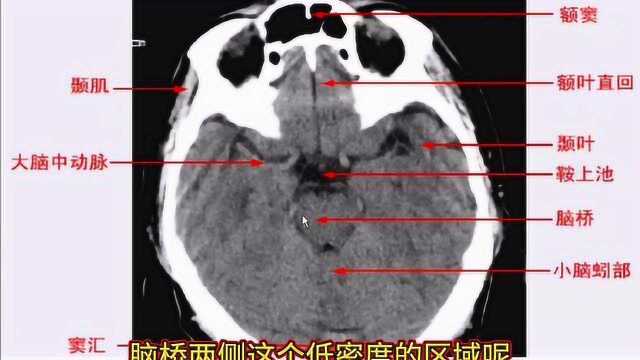 常规头颅CT解剖,放射科医生讲解,简单易懂