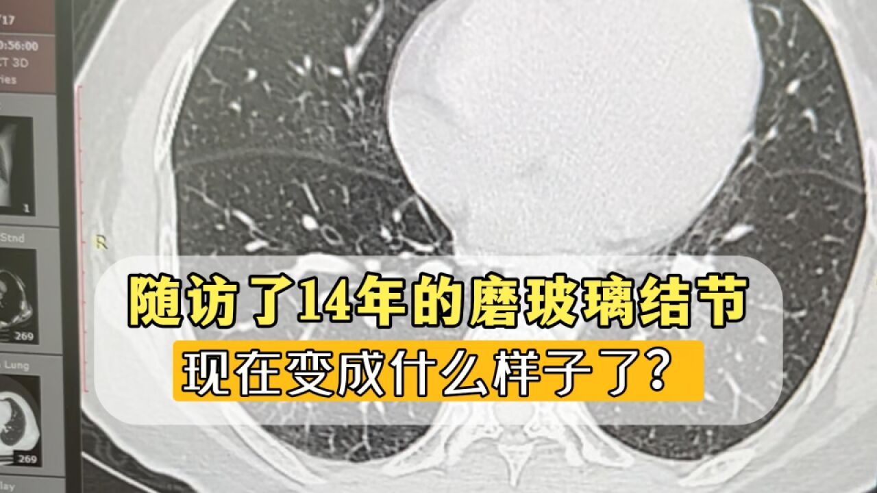 随访14年的肺磨玻璃结节,现在什么样了?医生直呼:很罕见