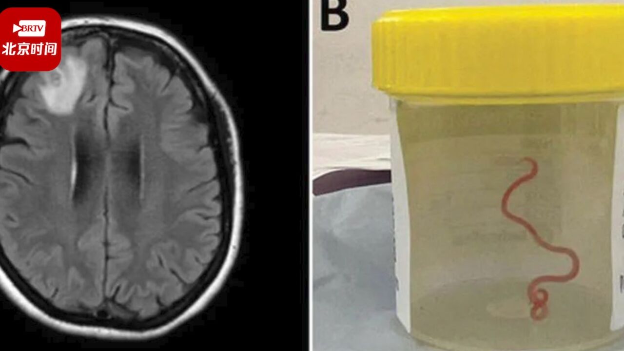 澳大利亚64岁女子大脑取出约8厘米长活蛔虫:肝脏和肺部也发现蛔虫