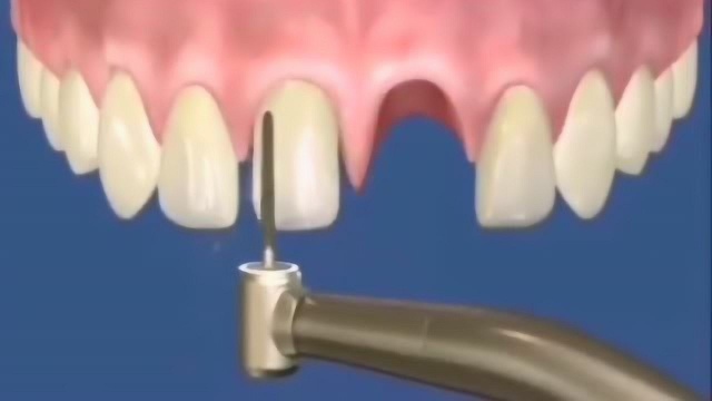 镶牙好还是种牙好,这就是镶牙的基本方式,不怕疼的人还是镶牙好!