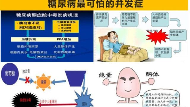 糖尿病有哪些危害?酮症酸中毒这个并发症最可怕,了解一下详情吧