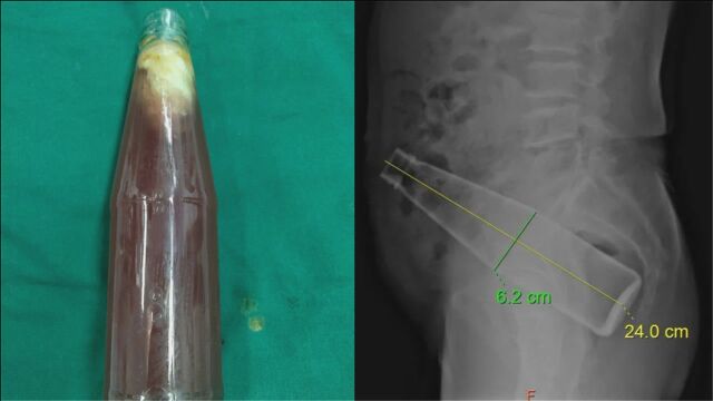 神操作!24厘米高玻璃瓶塞进男子肛门 医生奋战1个多小时取出
