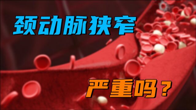 检查发现颈动脉狭窄,程度超过50%,这严不严重?判断标准是啥