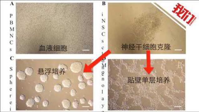 治疗帕金森病的研究成果参赛中关村论坛 可通过重编程移植患者脑中受损细胞