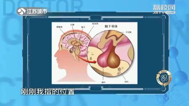 视力下降、视野变窄?警惕垂体长瘤!