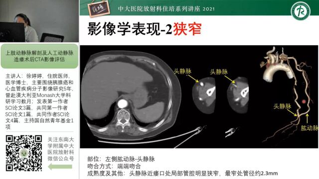 上肢动静脉解剖肌人工动静脉造瘘术后CTA影像评估中大徐婷婷