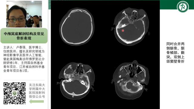 中颅窝底解剖结构及常见骨折征象中大卢春强