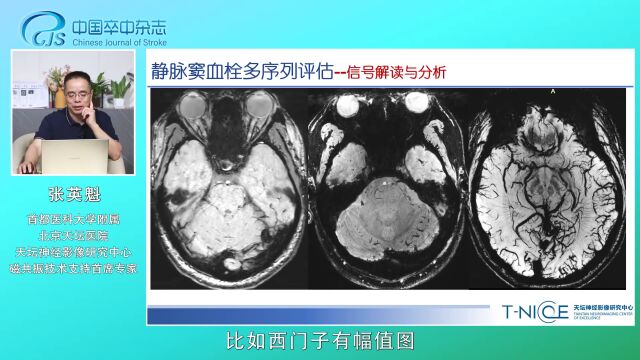 静脉窦血栓MRI多序列信号解读(一)