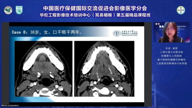 基于病例的腮腺非肿瘤性上皮病变的影像学分析思路上海交通大学医学院附属第九人民医院朱凌