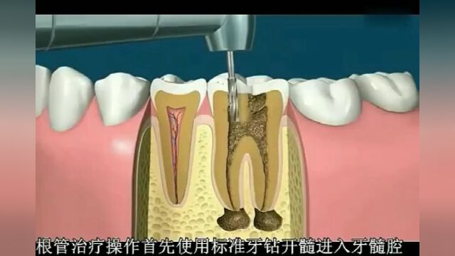 带你看看根管治疗的全过程