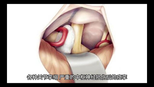 2023年09.22成都高谦联合宋道锋打造全国新内热针疼痛技术精讲培训班 限时特价980元