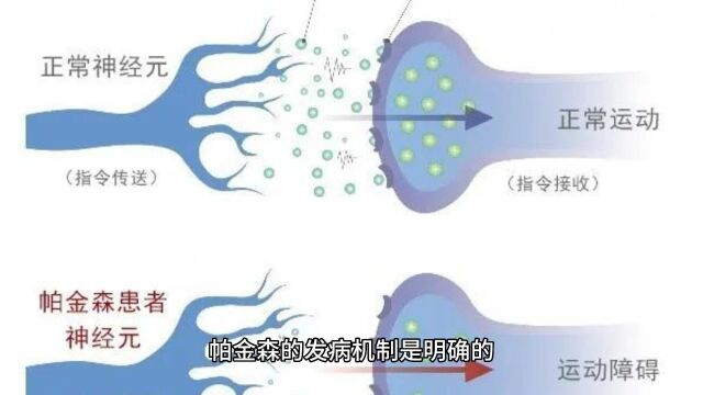 帕金森发病机制以及导致因素