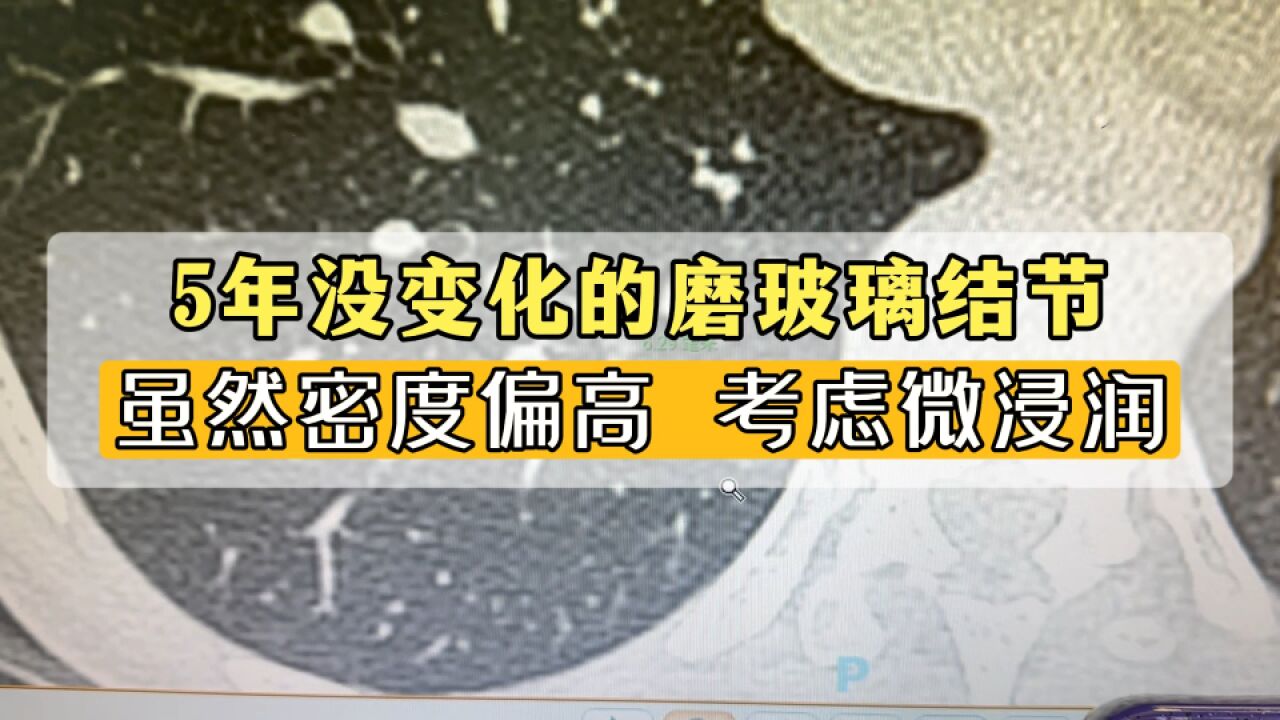 5年不变化的肺磨玻璃结节!虽然密度偏高,考虑是微浸润癌