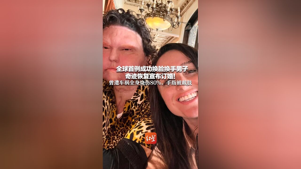 全球首例成功换脸换手男子 奇迹恢复宣布订婚!曾遭车祸全身烧伤80%,手指被截肢