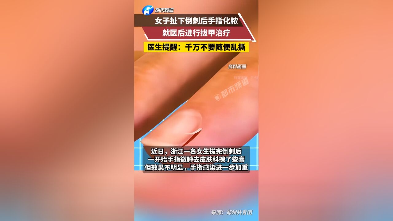 女子扯下倒刺后手指化脓 就医后进行拔甲治疗