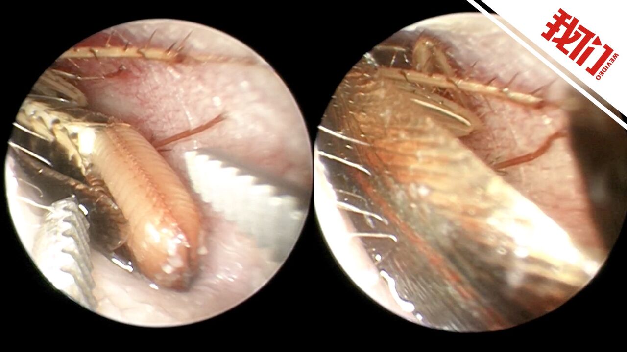 男子睡觉时一只产卵蟑螂钻进耳道 医生麻醉蟑螂后完整取出