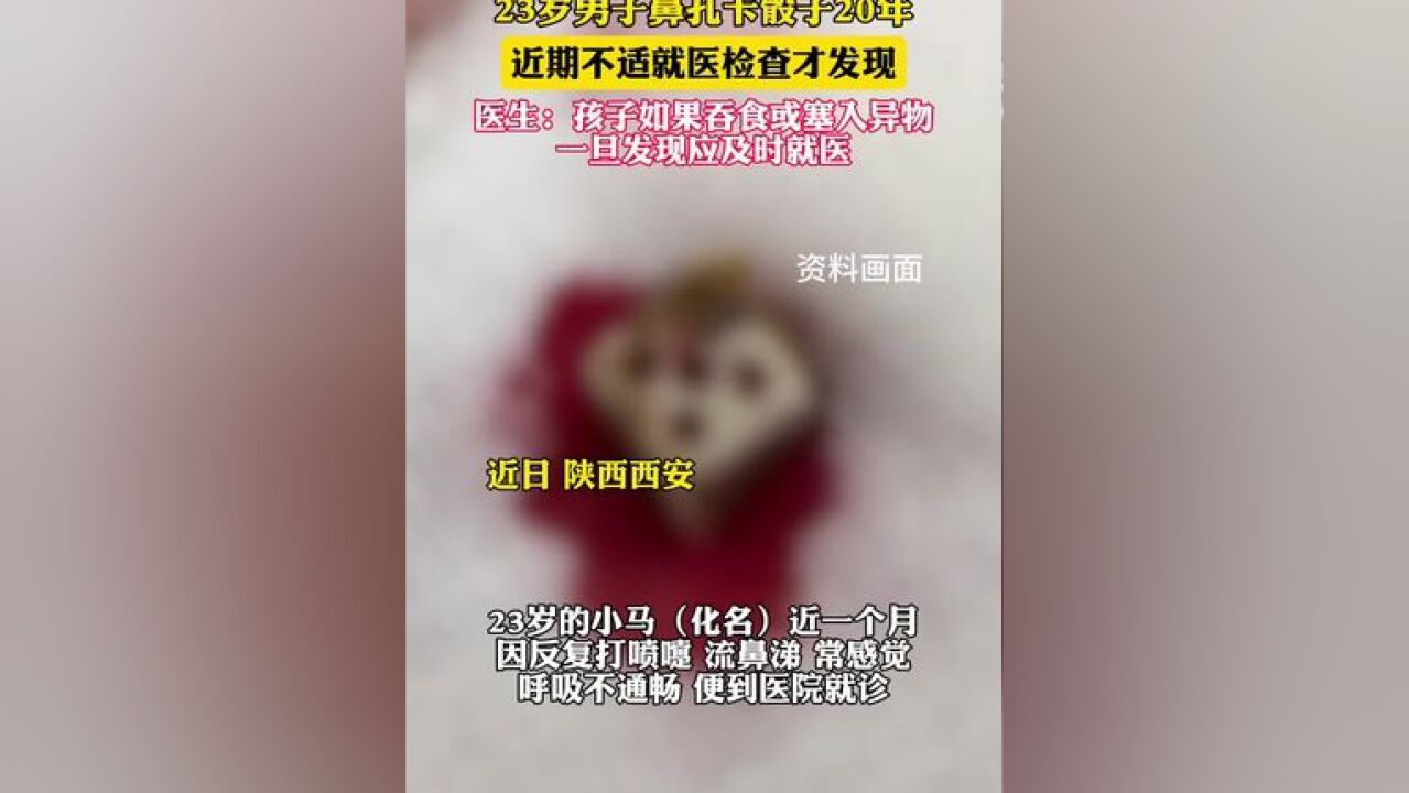 23岁男子鼻孔卡骰子20年;医生:孩子如果吞食或塞入异物,一旦发现应及时就医