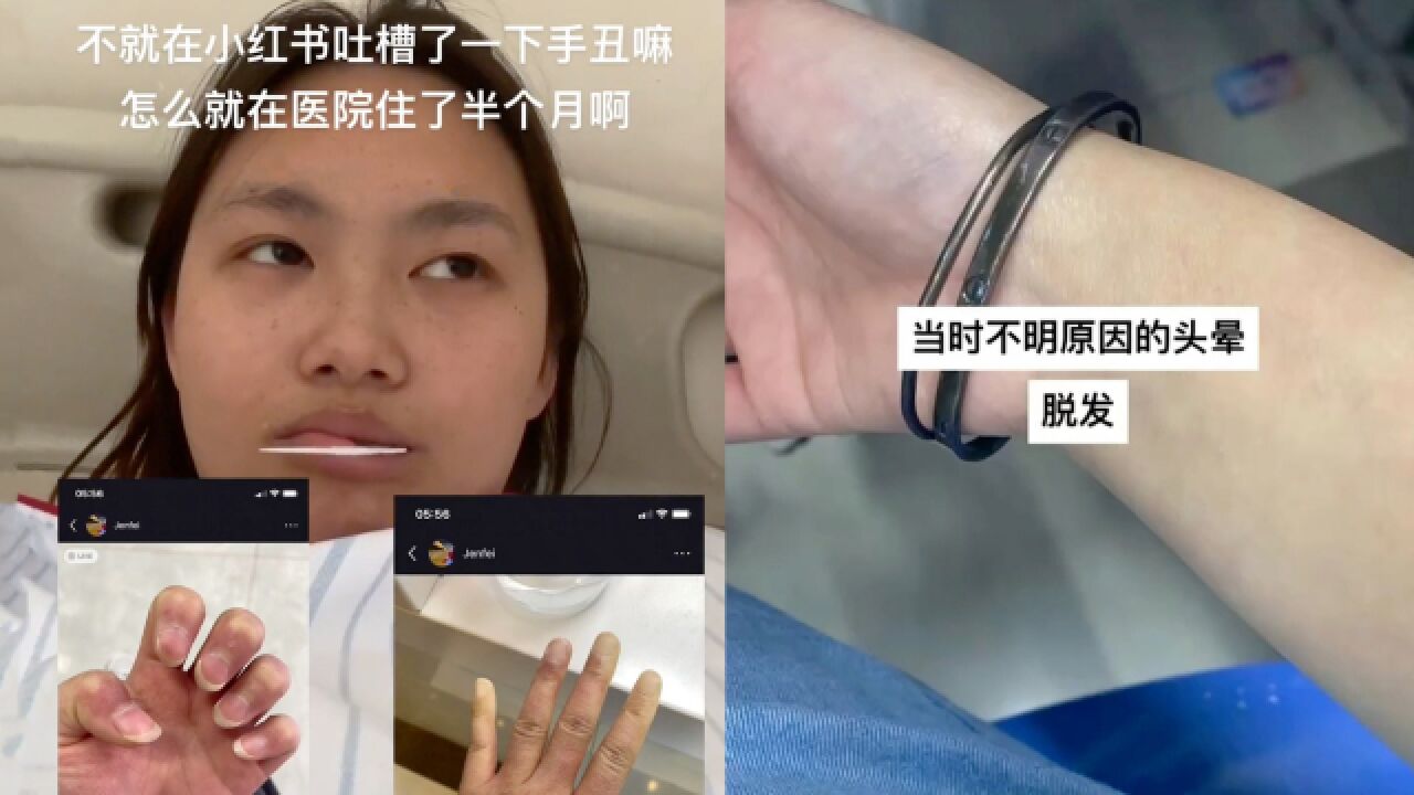 女子晒图吐槽手丑,网友提醒身体出问题竟真确诊红斑狼疮:救了我一命