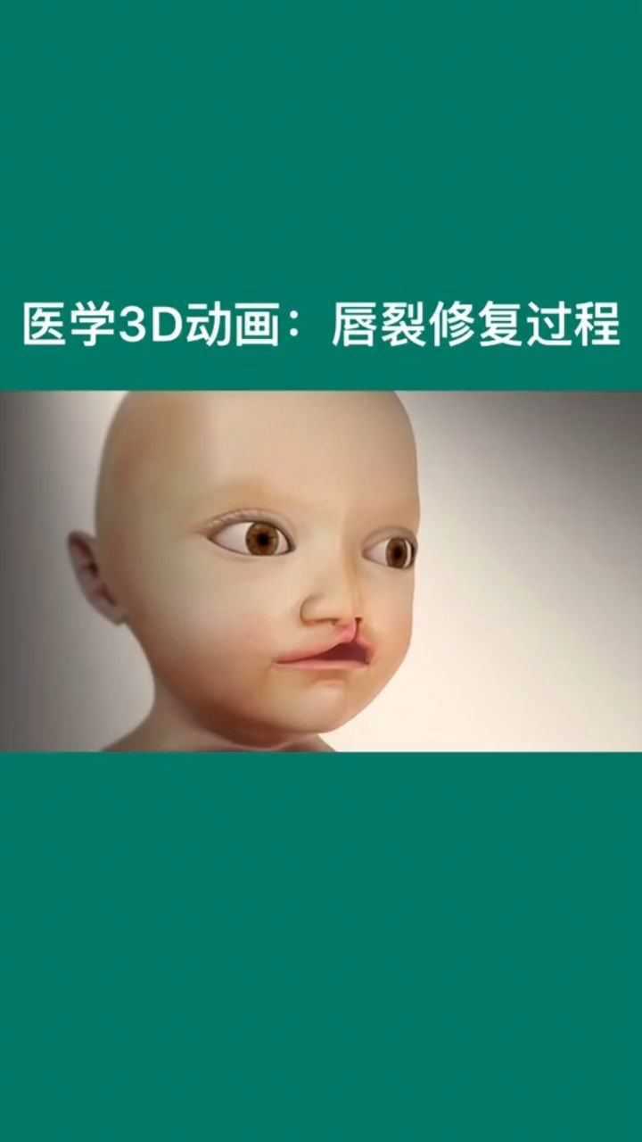 唇裂修复全过程