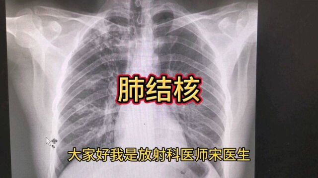 放射科医生带你了解肺结节在胸片上长什么样子,影像诊断要点有哪些?