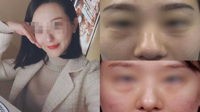 美女花8万整容却变丑,“返修”后眼都合不上,朋友曾夸她像明星