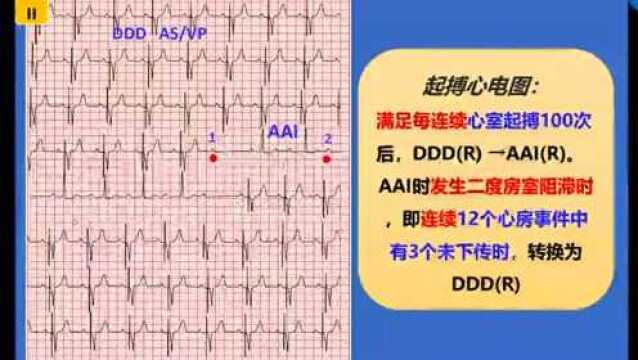 2022.01.12【专题版块】 第四十四期|邓国兰:起搏心电图长RR间期的解析思路