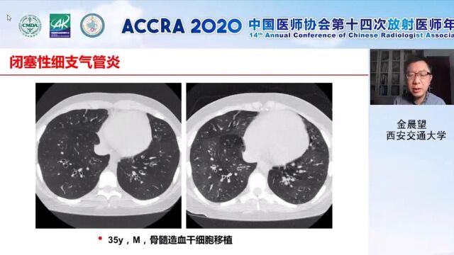 小气道疾病影像学评价及病理学基础西安交通大学第一附属医院金晨望