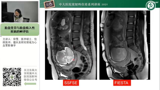 胎盘变异与胎盘植入性疾病的MR评估中大徐雪