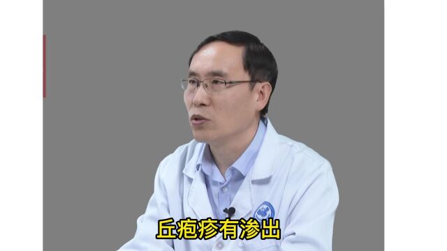 皮炎怎么办?用什么治疗 下