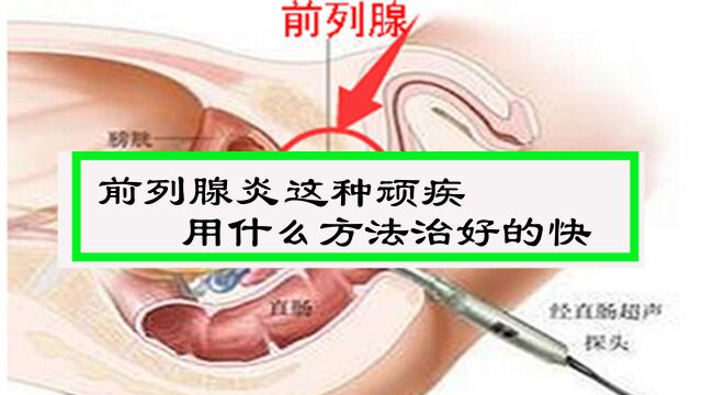 前列腺炎这个顽疾怎样才能完全治好?