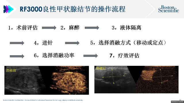 射频消融在甲状腺上的应用