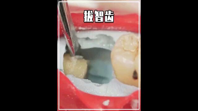 牙疼怎么治